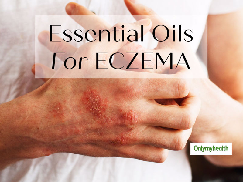Eczema Care: Essential Oils To Soothe The Irritated Skin
